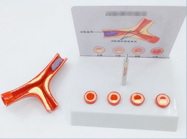 Vascular Anatomy Atheroscosis Teaching Model