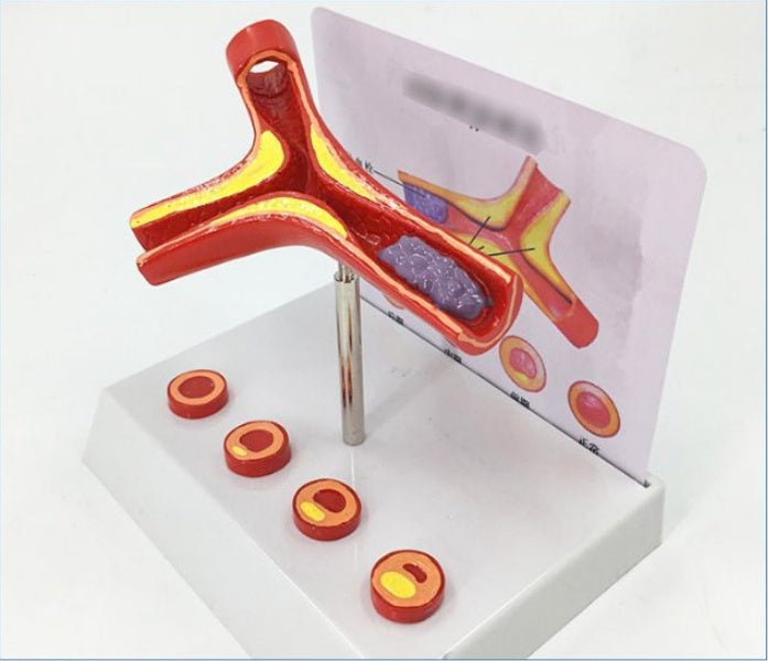 Vascular Anatomy Atheroscosis Teaching Model