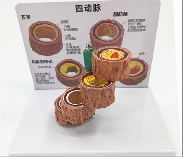 Vascular Anatomy Atheroscosis Teaching Model