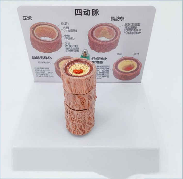 Vascular Anatomy Atheroscosis Teaching Model