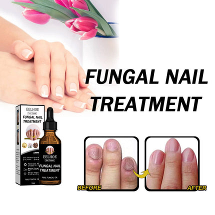 Onychomycosis Dead Skin And Repairing Lotion