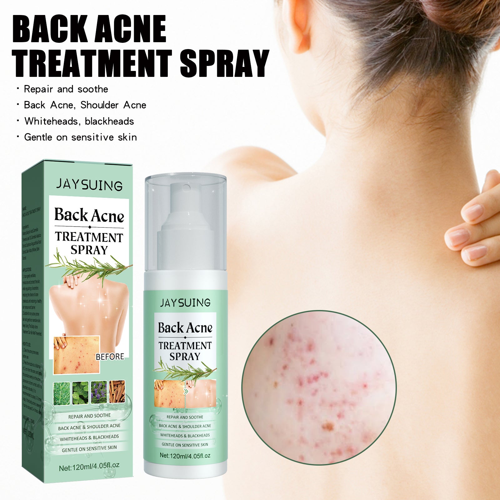 Jaysuing Back Acne Repair Spray, Repair Body Acne Fade Acne Mark Skin Care Spray