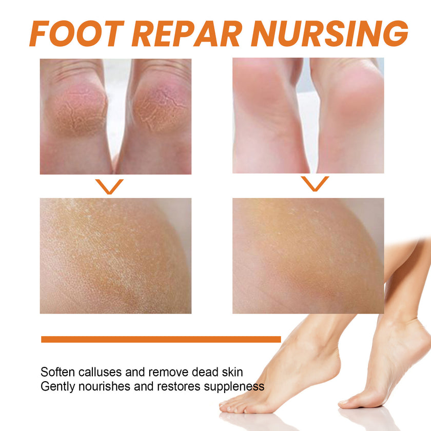 Foot Exfoliating Spray Mild Callose Remove Dead Skin