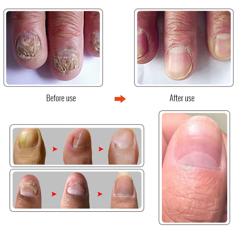 Onychomycosis Care Solution To Repair Hands And Feet
