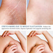 Stretch Mark Remover Essential Oil Care Cream