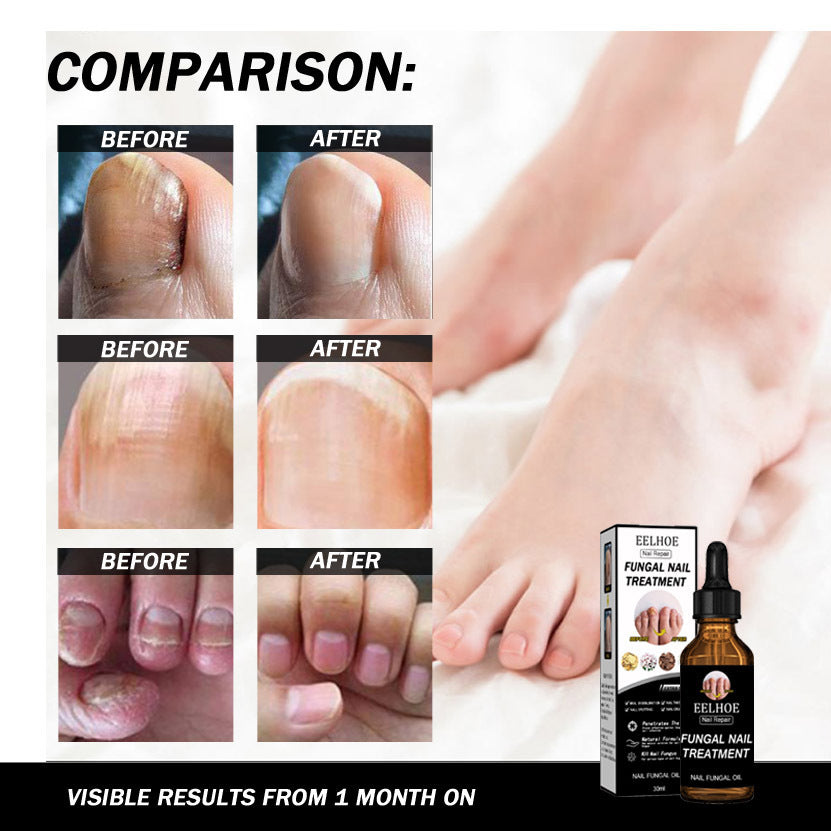 Onychomycosis Dead Skin And Repairing Lotion