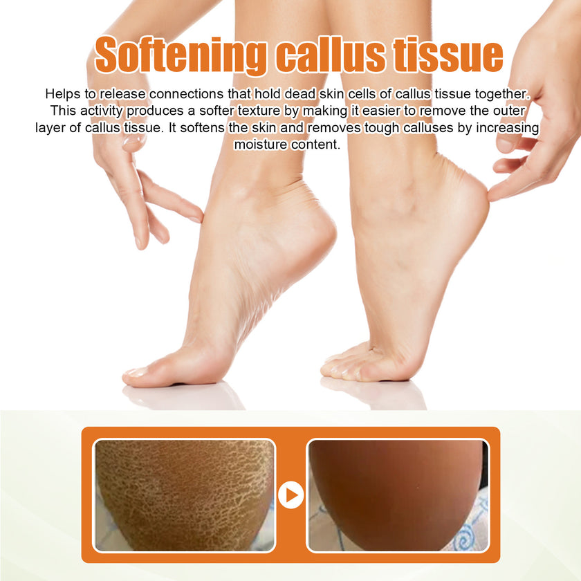 Foot Exfoliating Spray Mild Callose Remove Dead Skin