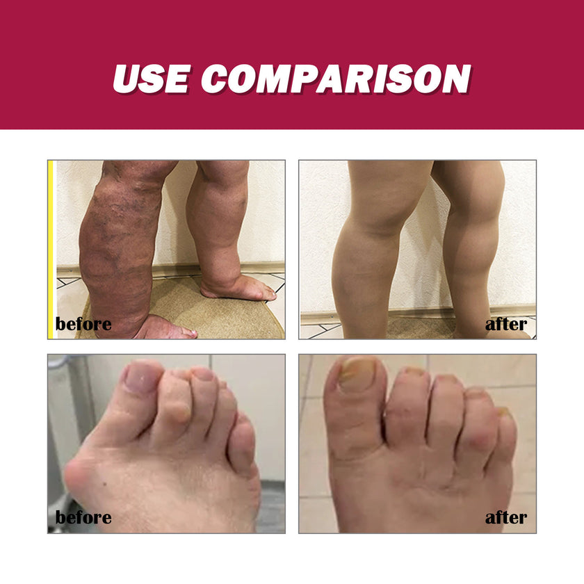 Protein Cream Soothes Joint Bone Soreness, Deformation, Correction And Repair Alpscommerce