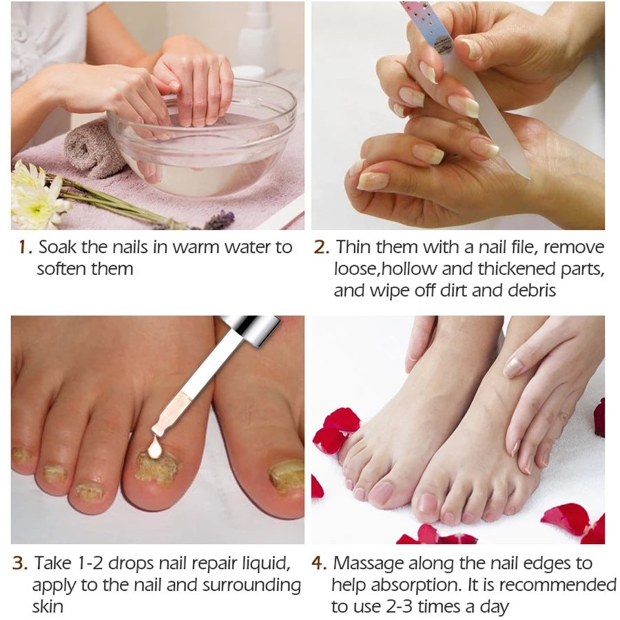 Thickening Of Special Bacteriostatic Liquid For Onychomycosis