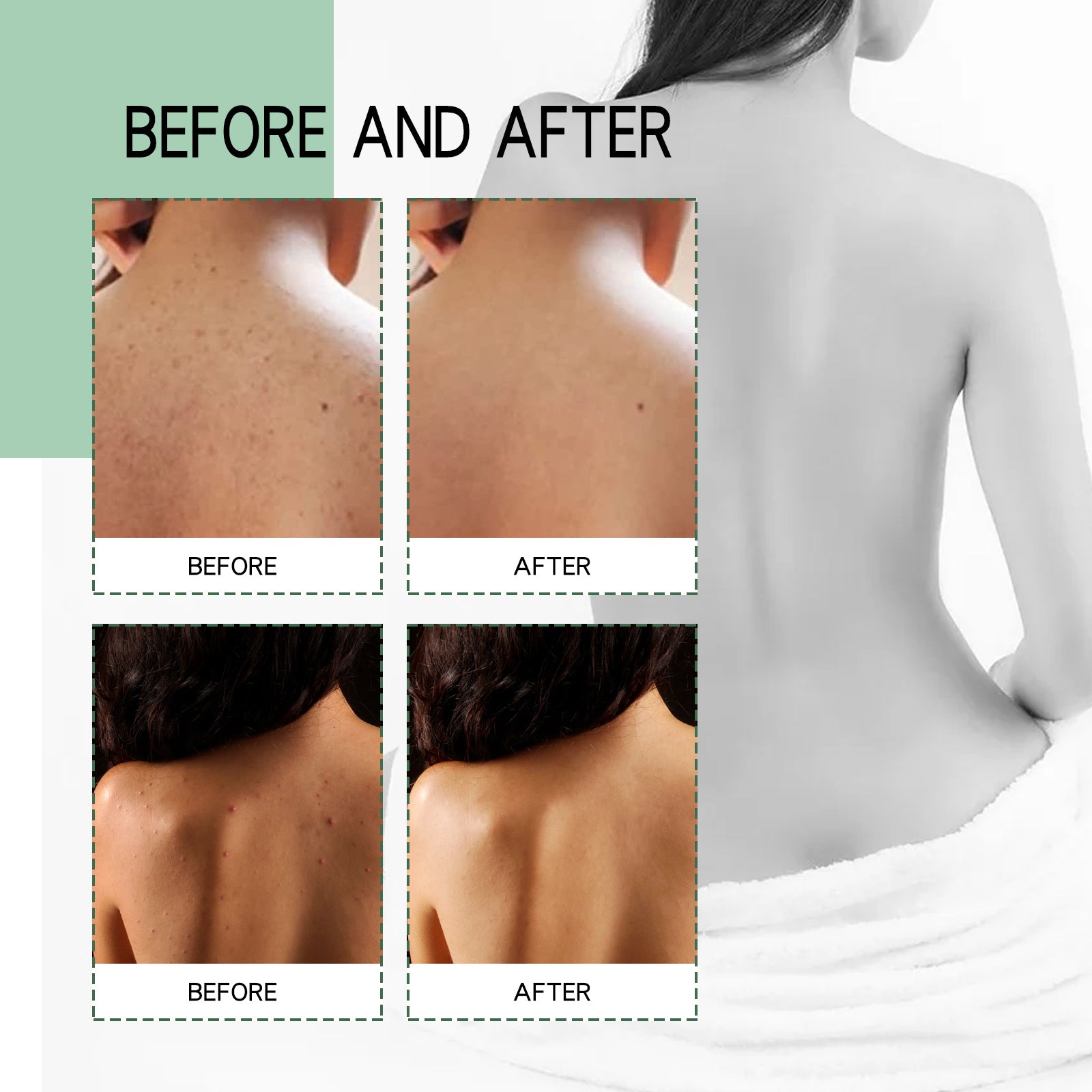 Jaysuing Back Acne Repair Spray, Repair Body Acne Fade Acne Mark Skin Care Spray