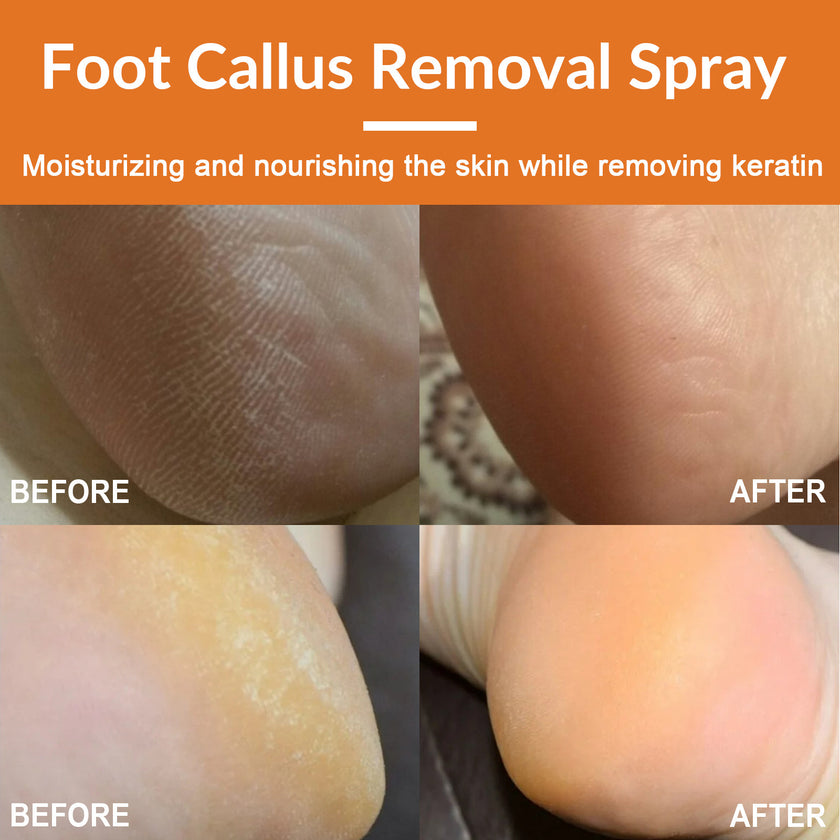 Dead Skin Cleaning And Repair Spray