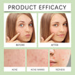 Acne Miracle Patch Removes Pimples Skin Care