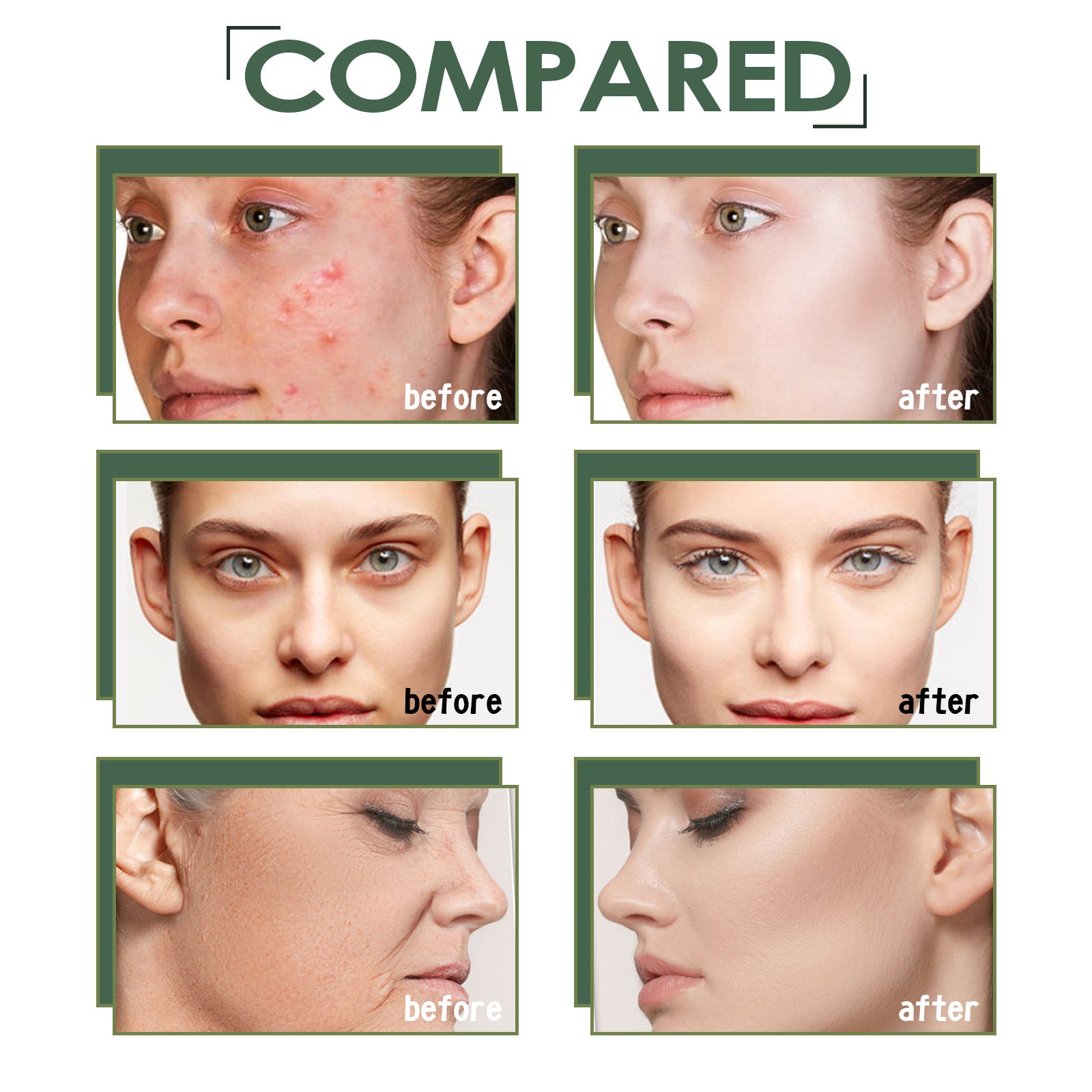 Acne Marks Blackhead Brightening Skin